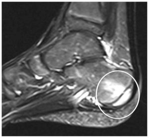 (Achilles Enthesis Organ; from Kehl et al., 2016)