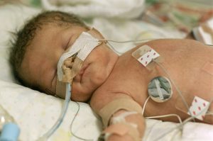Ventilatory Efficiency in Children and Adolescents Born Extremely Preterm. Ventilatory Efficiency in Children and Adolescents Born Extremely Preterm.