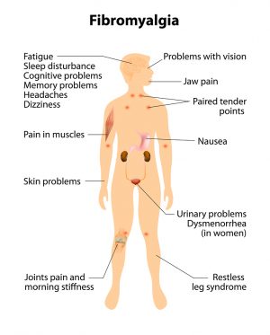 Fibromyalgia Syndrome: The Elephant in the Room? Fibromyalgia Syndrome: The Elephant in the Room?