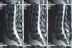 MRI SPine showing Disc Herniation