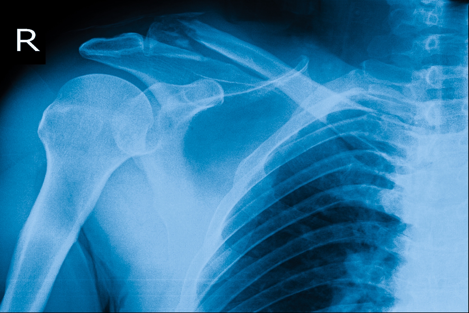 xray image show right shoulder and frozen shoulder