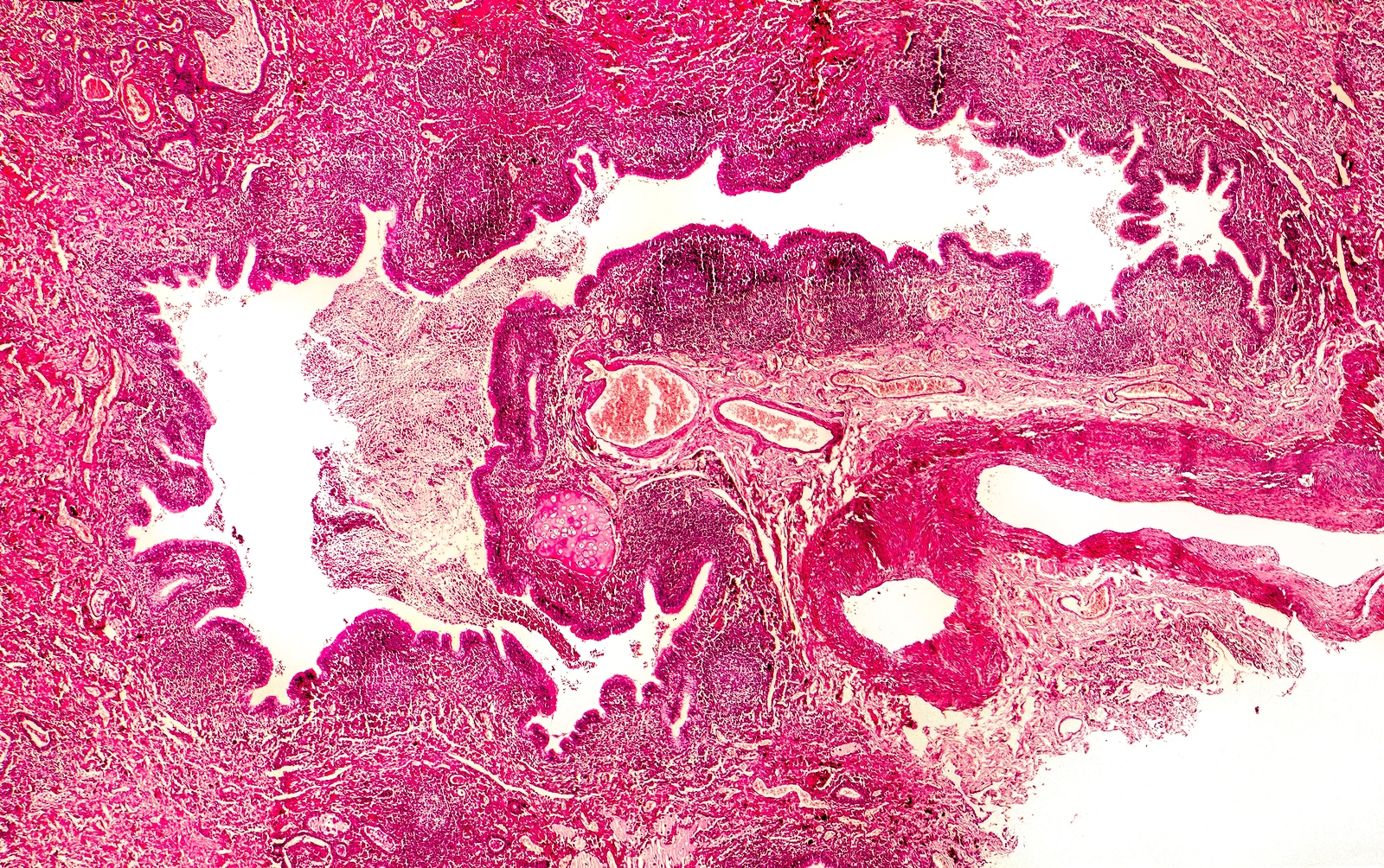 Bronchiectasis lung cross section