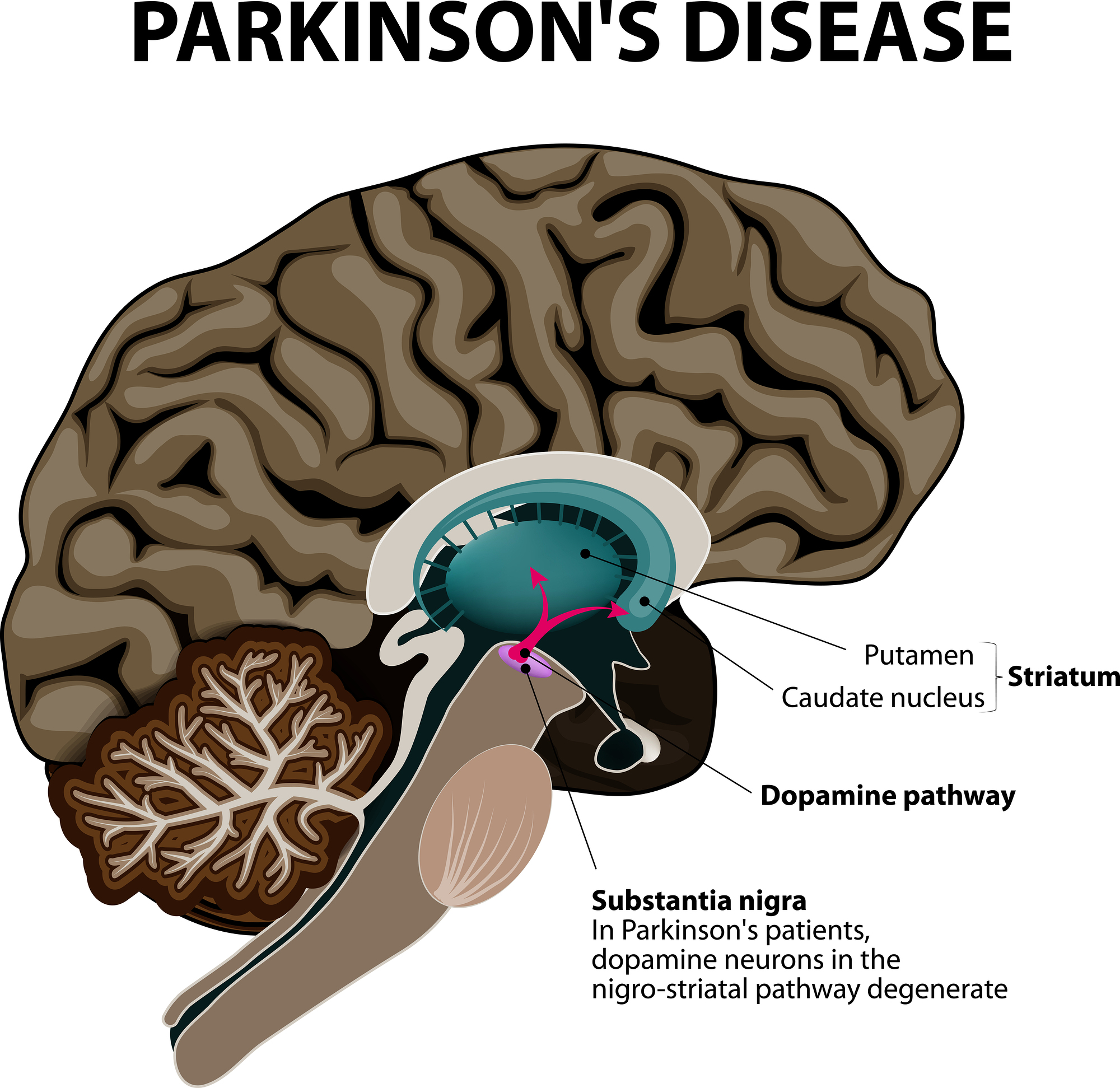 HighIntensity Exercise Increases Substantia Nigra & Prefrontal Brain