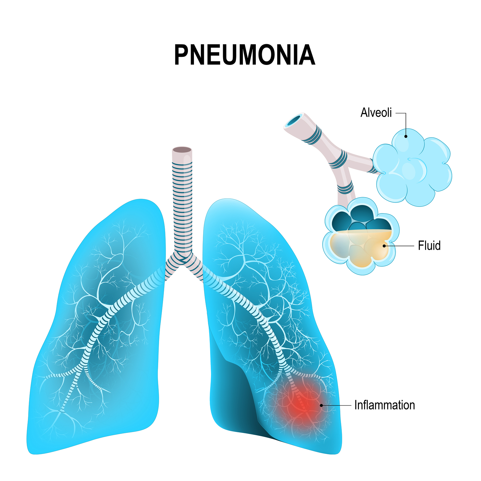Pneumonia