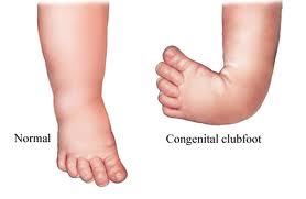 Infants feet - Choose physio  Australian Physiotherapy Association